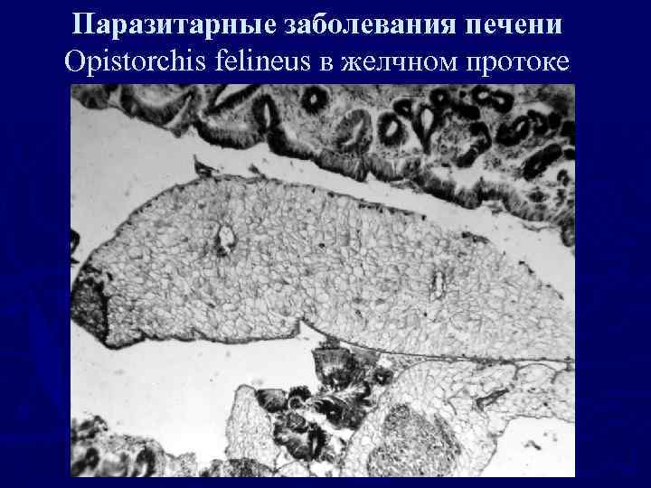 Паразитарные заболевания печени Opistorchis felineus в желчном протоке 