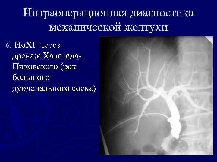 Интраоперационная диагностика механической желтухи 6. Ио. ХГ через дренаж Халстеда. Пиковского (рак большого дуоденального