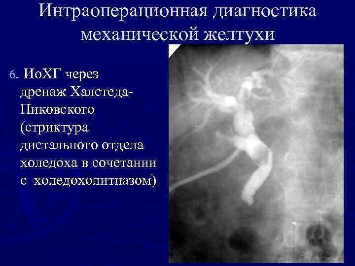 Интраоперационная диагностика механической желтухи 6. Ио. ХГ через дренаж Халстеда. Пиковского (стриктура дистального отдела