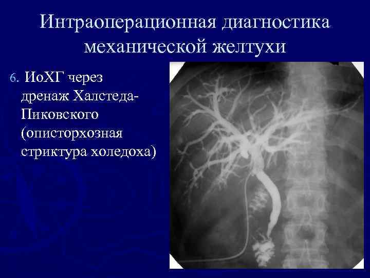 Интраоперационная диагностика механической желтухи 6. Ио. ХГ через дренаж Халстеда. Пиковского (описторхозная стриктура холедоха)