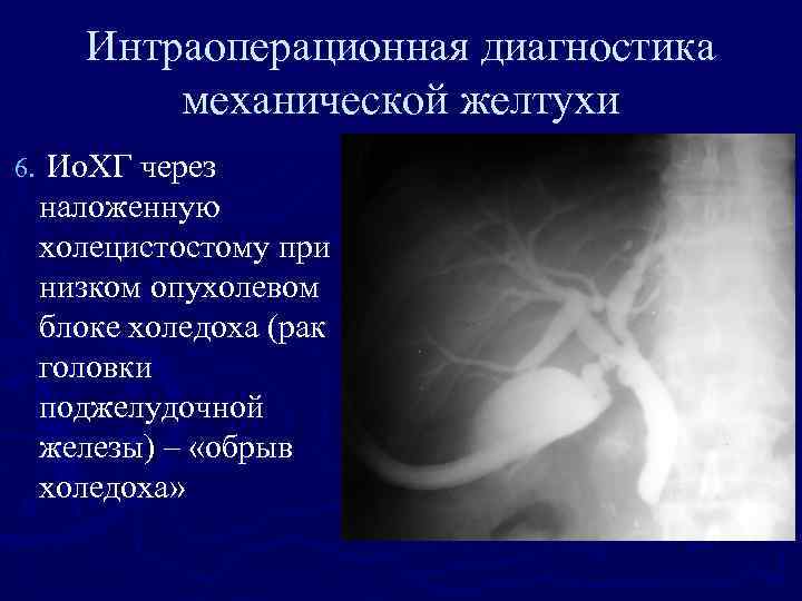 Интраоперационная диагностика механической желтухи 6. Ио. ХГ через наложенную холецистостому при низком опухолевом блоке
