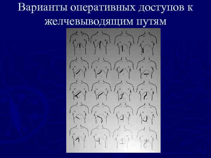 Варианты оперативных доступов к желчевыводящим путям 