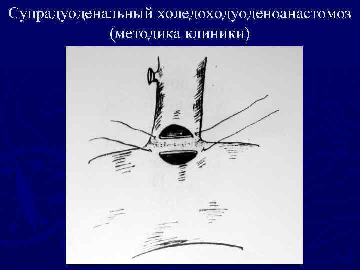 Супрадуоденальный холедоходуоденоанастомоз (методика клиники) 