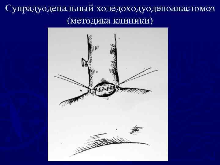 Супрадуоденальный холедоходуоденоанастомоз (методика клиники) 