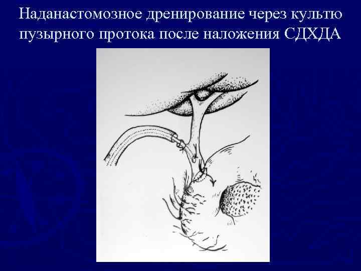 Наданастомозное дренирование через культю пузырного протока после наложения СДХДА 