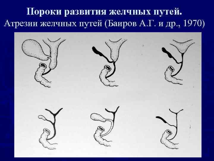 Пороки развития желчных путей. Атрезии желчных путей (Баиров А. Г. и др. , 1970)