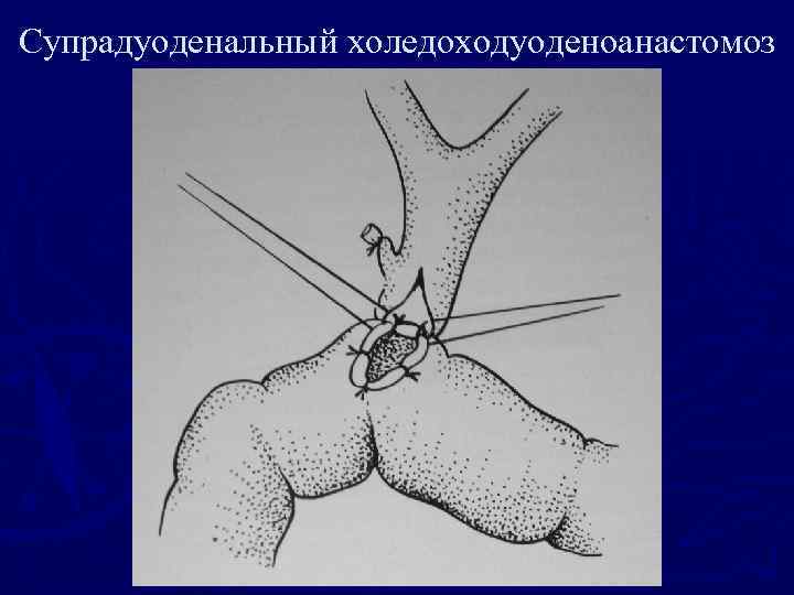 Супрадуоденальный холедоходуоденоанастомоз 
