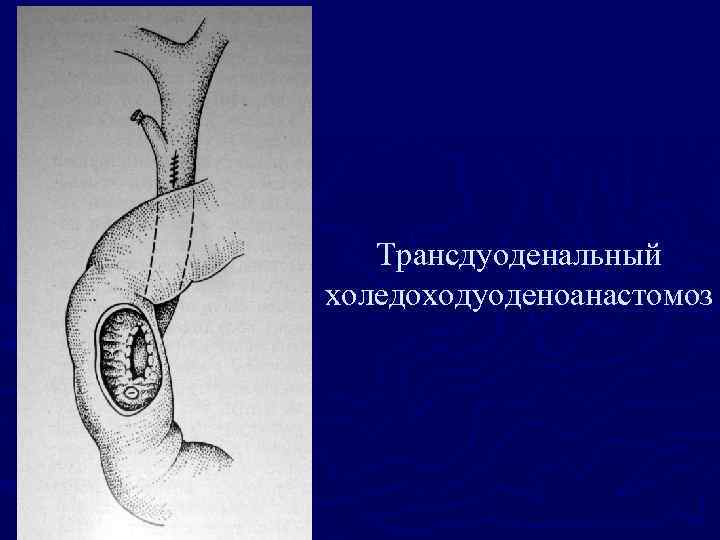 Трансдуоденальный холедоходуоденоанастомоз 
