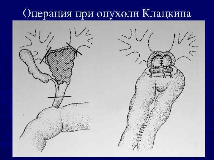 Операция при опухоли Клацкина 