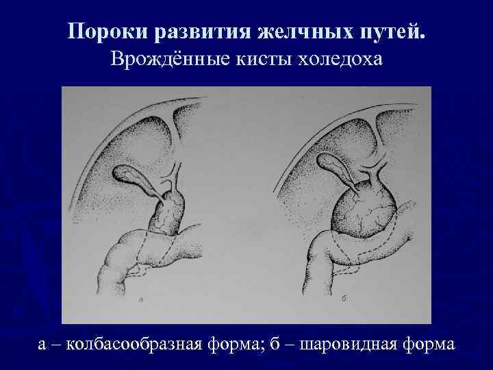 Пороки развития желчных путей. Врождённые кисты холедоха а – колбасообразная форма; б – шаровидная