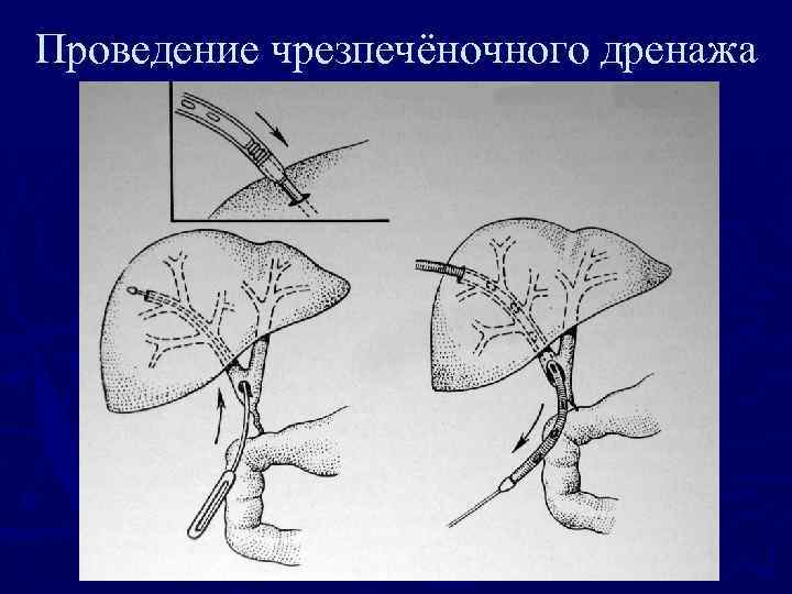 Проведение чрезпечёночного дренажа 