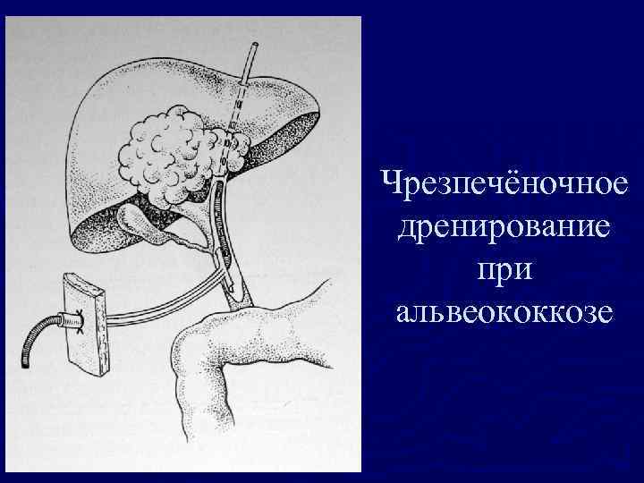Чрезпечёночное дренирование при альвеококкозе 
