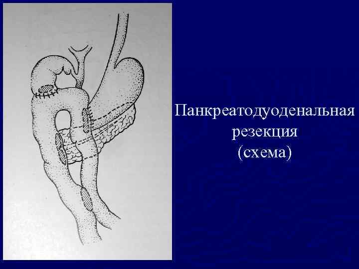 Панкреатодуоденальная резекция (схема) 