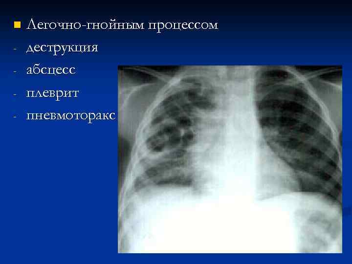 n - Легочно-гнойным процессом деструкция абсцесс плеврит пневмоторакс 