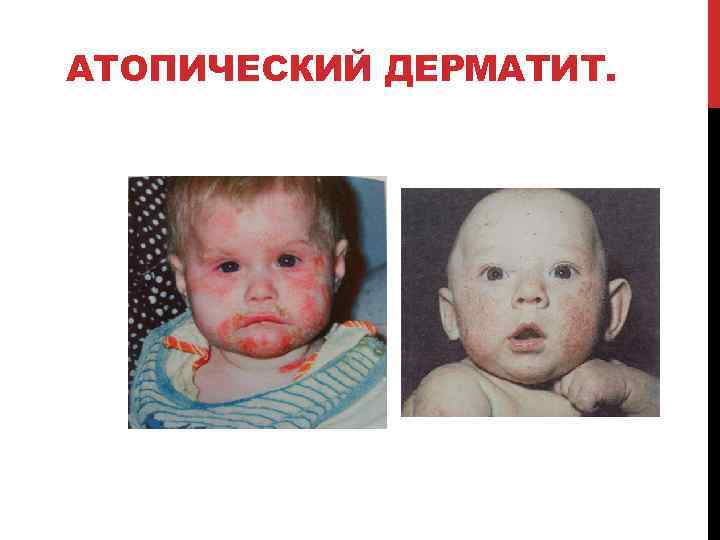 АТОПИЧЕСКИЙ ДЕРМАТИТ. 