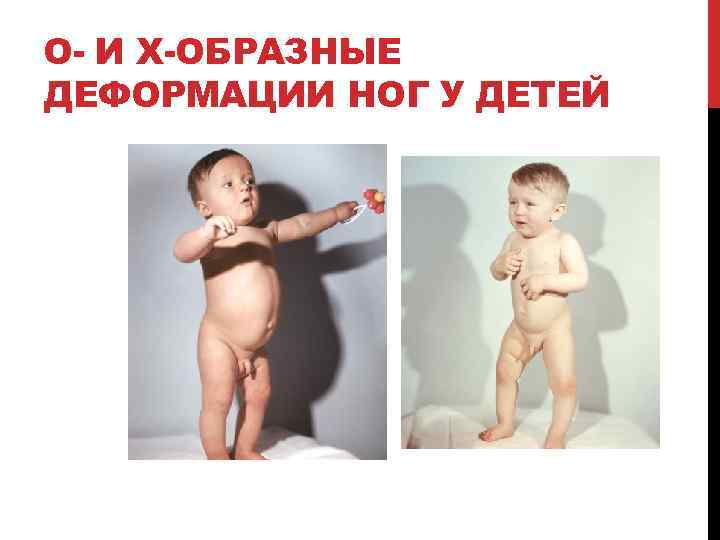 О- И Х-ОБРАЗНЫЕ ДЕФОРМАЦИИ НОГ У ДЕТЕЙ 