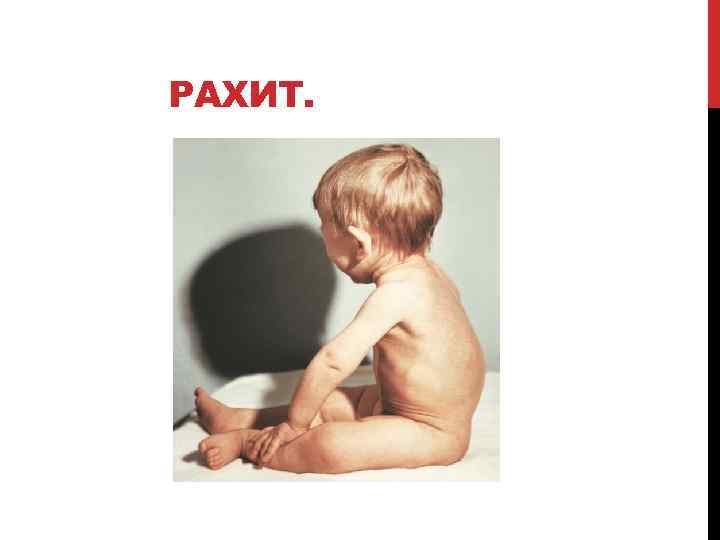 РАХИТ. 