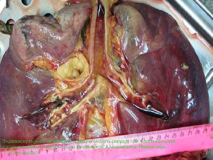 Эндоваскулярная окклюзия кровоточащего сосуда при бронхиальной артериографии (презентация Владимира Алексеевича Порханова,  г. Краснодар)