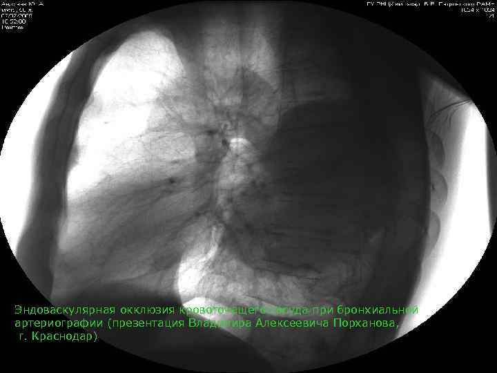Эндоваскулярная окклюзия кровоточащего сосуда при бронхиальной артериографии (презентация Владимира Алексеевича Порханова,  г. Краснодар)