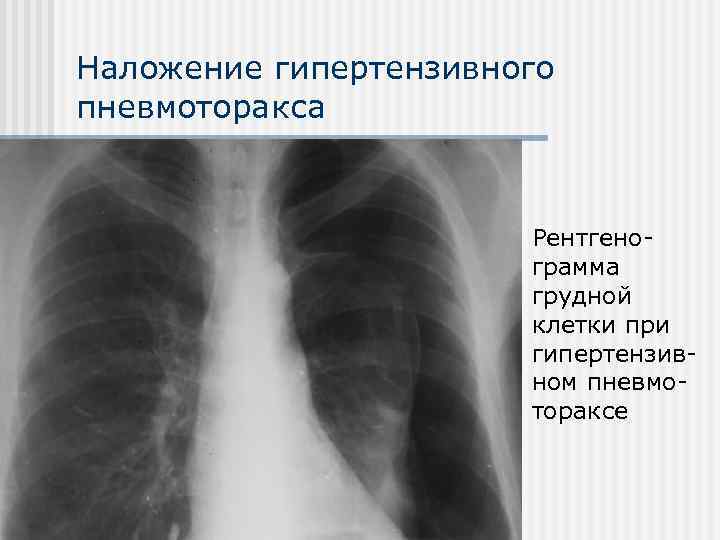 Наложение гипертензивного пневмоторакса      Рентгено-    грамма 