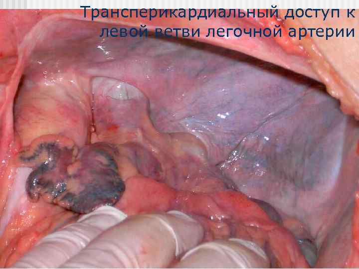 Трансперикардиальный доступ к  левой ветви легочной артерии 