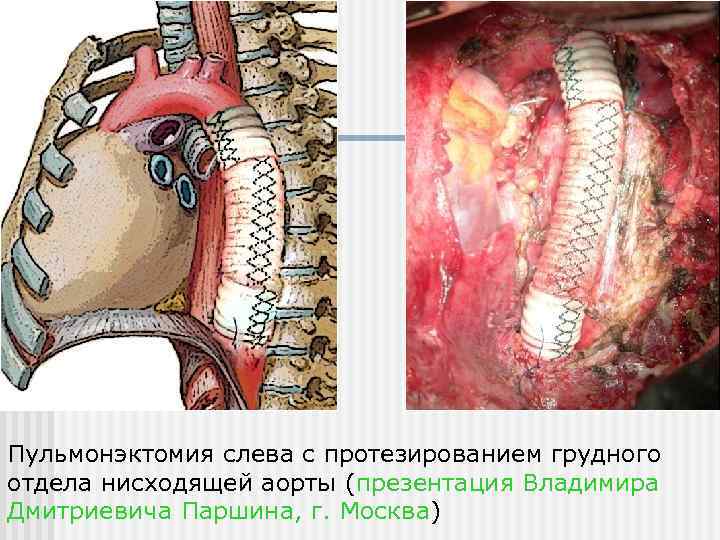 Пульмонэктомия слева с протезированием грудного отдела нисходящей аорты (презентация Владимира Дмитриевича Паршина, г. Москва)