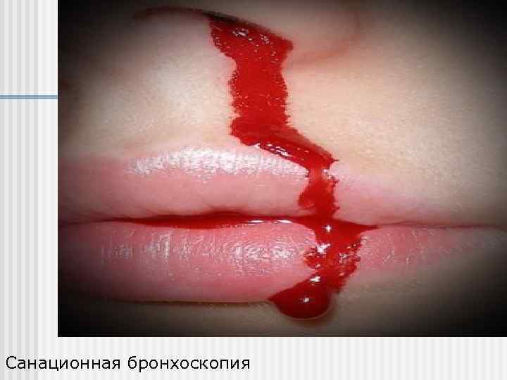 Санационная бронхоскопия 