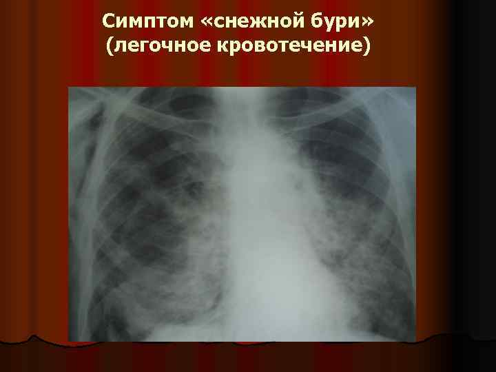 Симптом «снежной бури» (легочное кровотечение) 