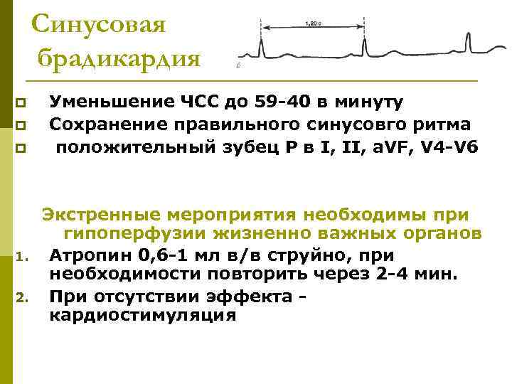  Синусовая брадикардия p Уменьшение ЧСС до 59 -40 в минуту p Сохранение правильного
