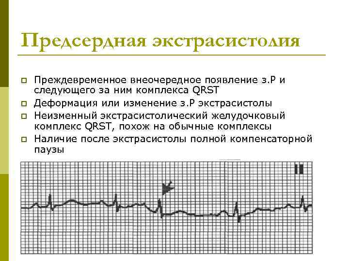 Предсердная экстрасистолия p  Преждевременное внеочередное появление з. Р и следующего за ним комплекса