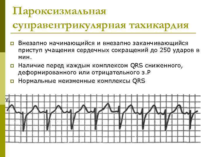 Пароксизмальная суправентрикулярная тахикардия p  Внезапно начинающийся и внезапно заканчивающийся приступ учащения сердечных сокращений