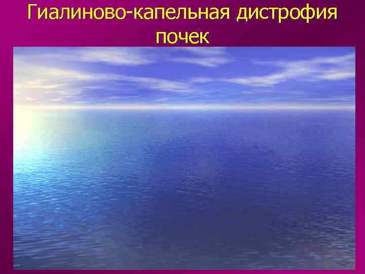 Гиалиново-капельная дистрофия   почек 