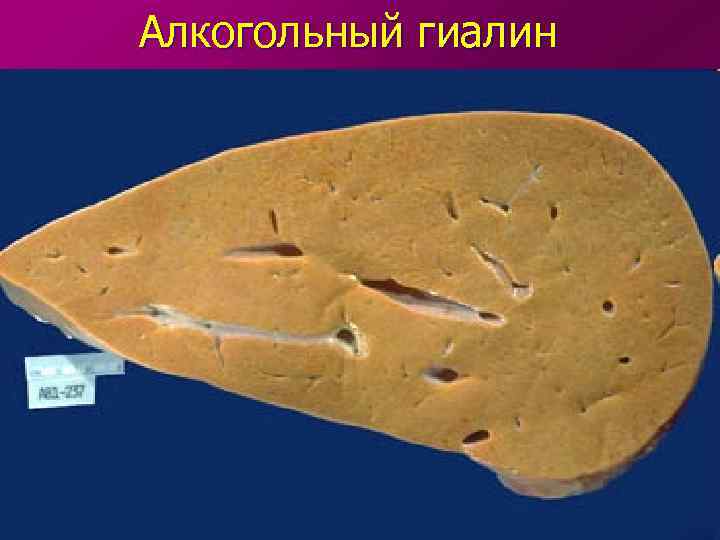 Алкогольный гиалин 