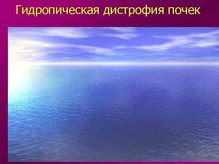 Гидропическая дистрофия почек 