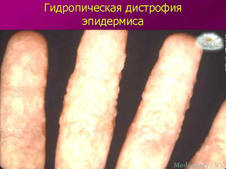 Гидропическая дистрофия  эпидермиса 