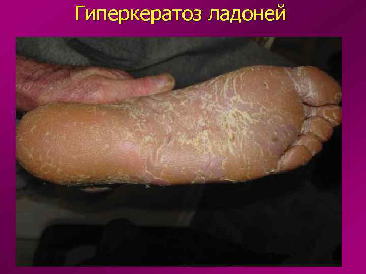 Гиперкератоз ладоней 