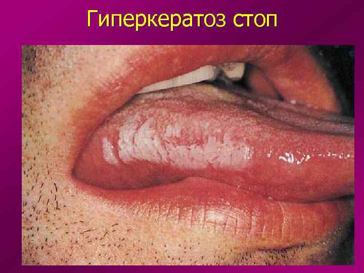 Гиперкератоз стоп 