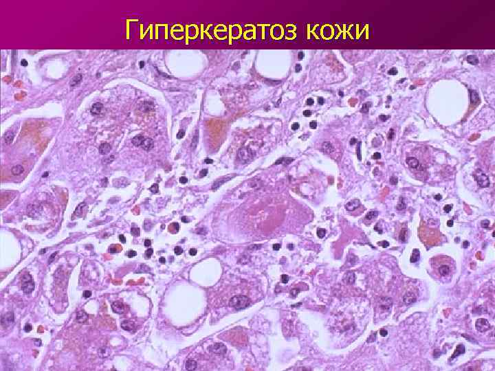 Гиперкератоз кожи 