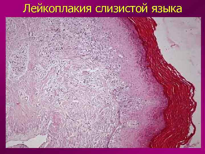 Лейкоплакия слизистой языка 