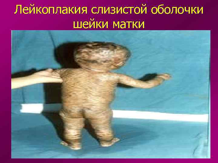 Лейкоплакия слизистой оболочки   шейки матки 