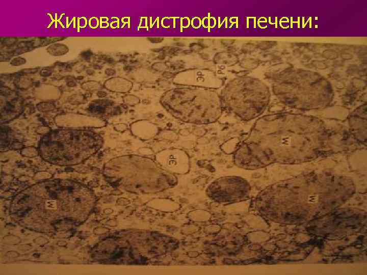 Жировая дистрофия печени: 