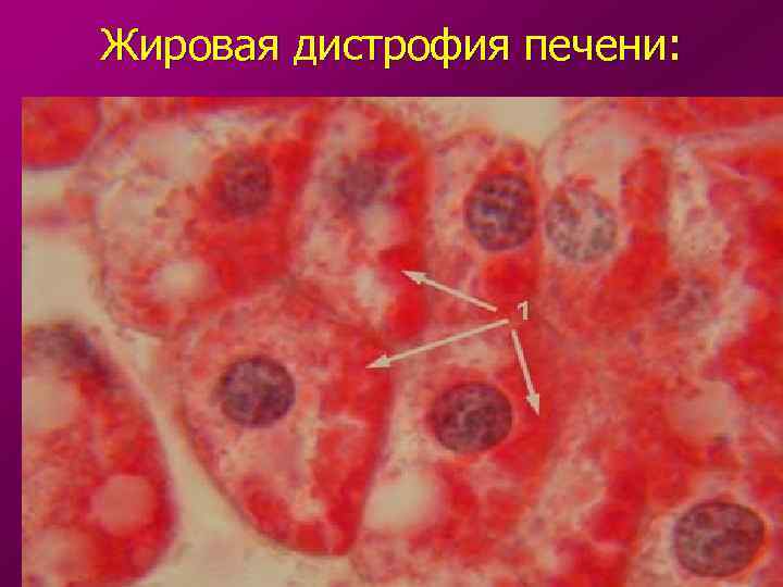 Жировая дистрофия печени: 