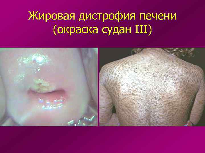 Жировая дистрофия печени  (окраска судан III) 