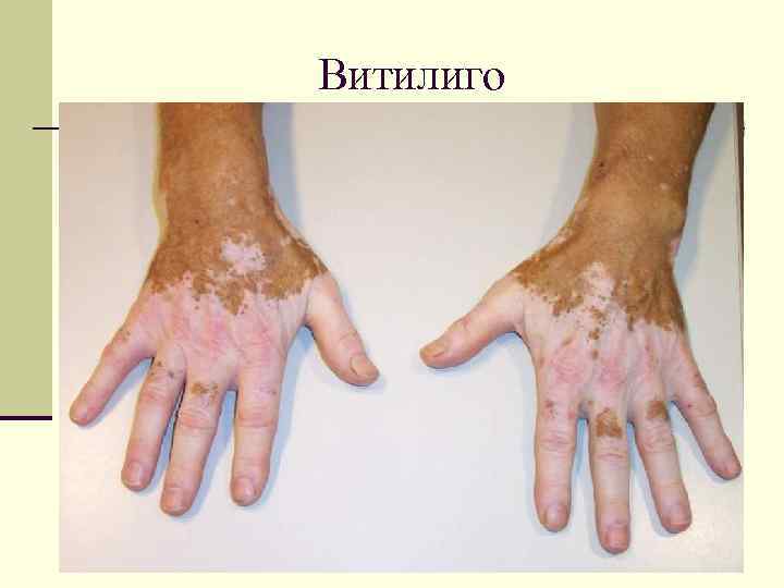 Витилиго 