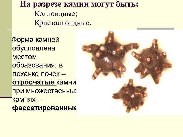  На разрезе камни могут быть:  Коллоидные;  Кристаллоидные.  Форма камней обусловлена