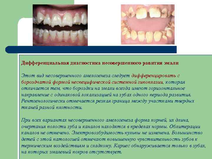 Дифференциальная диагностика несовершенного равития эмали Этот вид несовершенного амелогенеза следует дифференцировать с бороздчатой формой