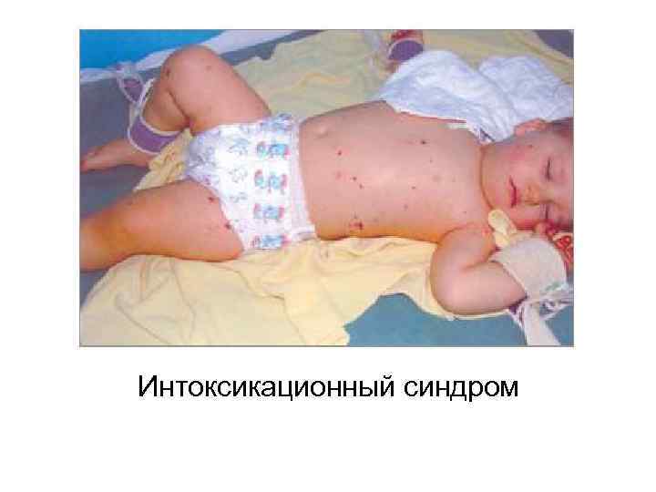 Интоксикационный синдром 