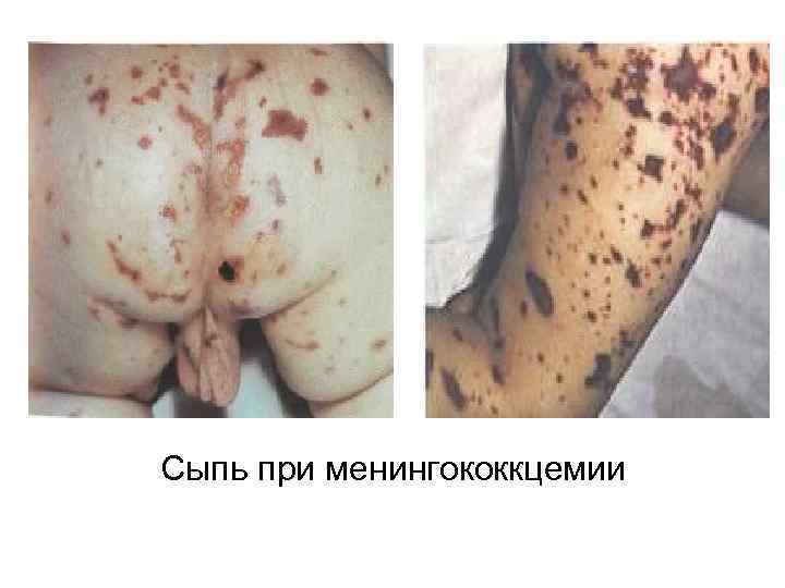 Сыпь при менингококкцемии 