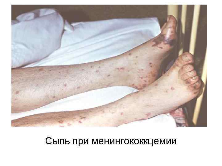 Сыпь при менингококкцемии 