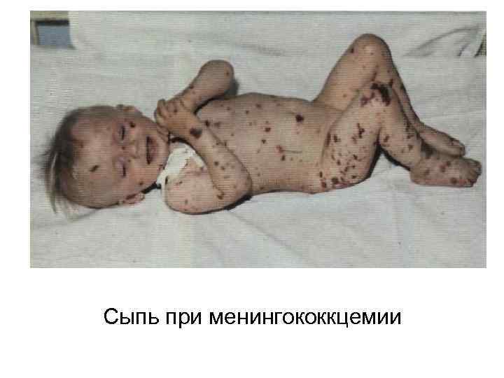 Сыпь при менингококкцемии 